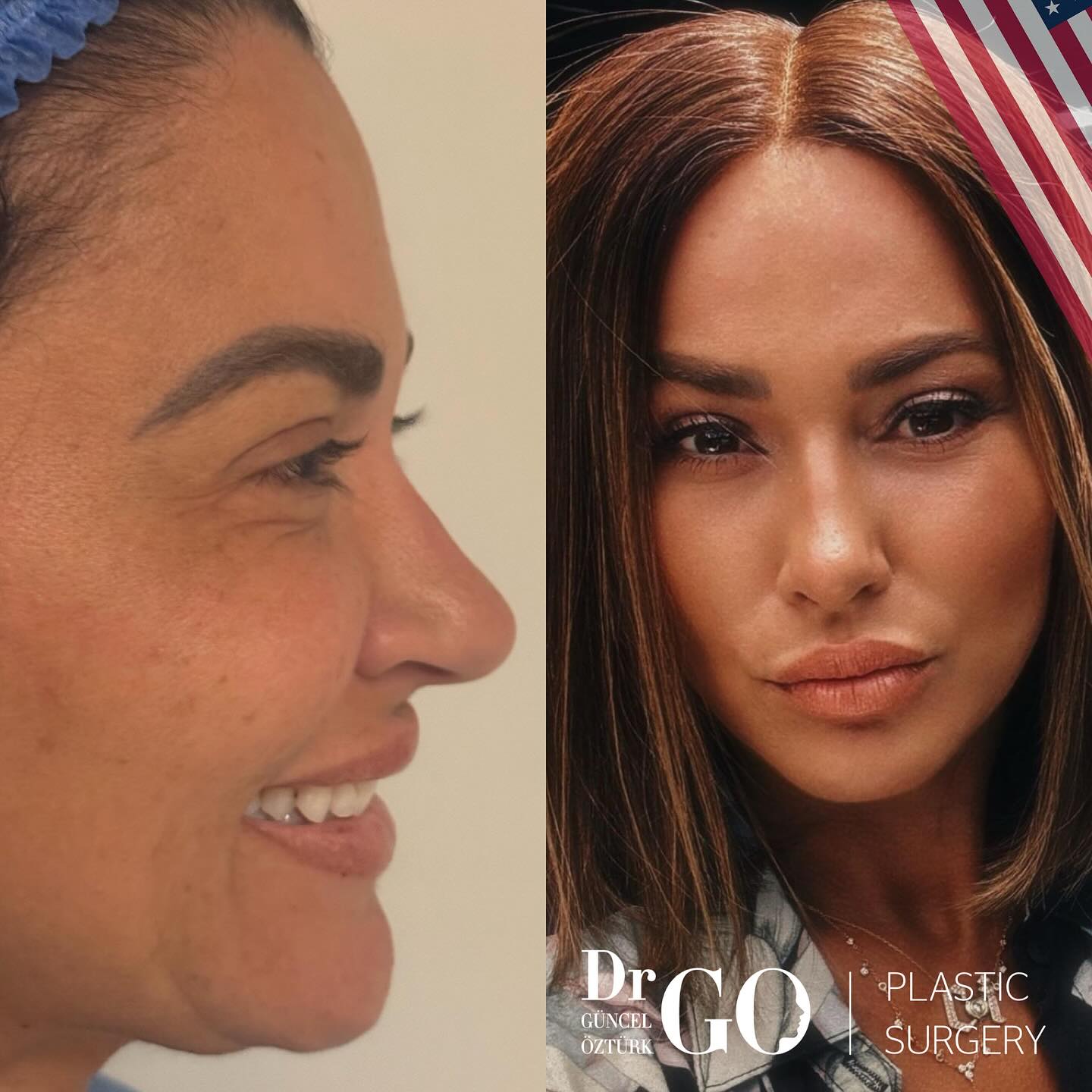 best rhinoplasty in turkey